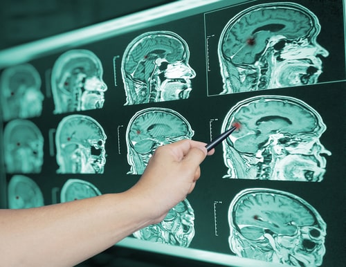 Neurology specialist identifies in issue in the brain on a scan