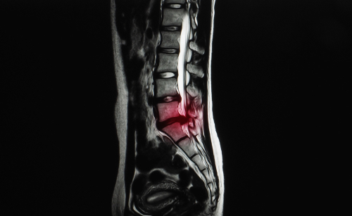 Endoscopic spine surgery, Charlotte spine surgery, Charlotte endoscopic spine surgery.